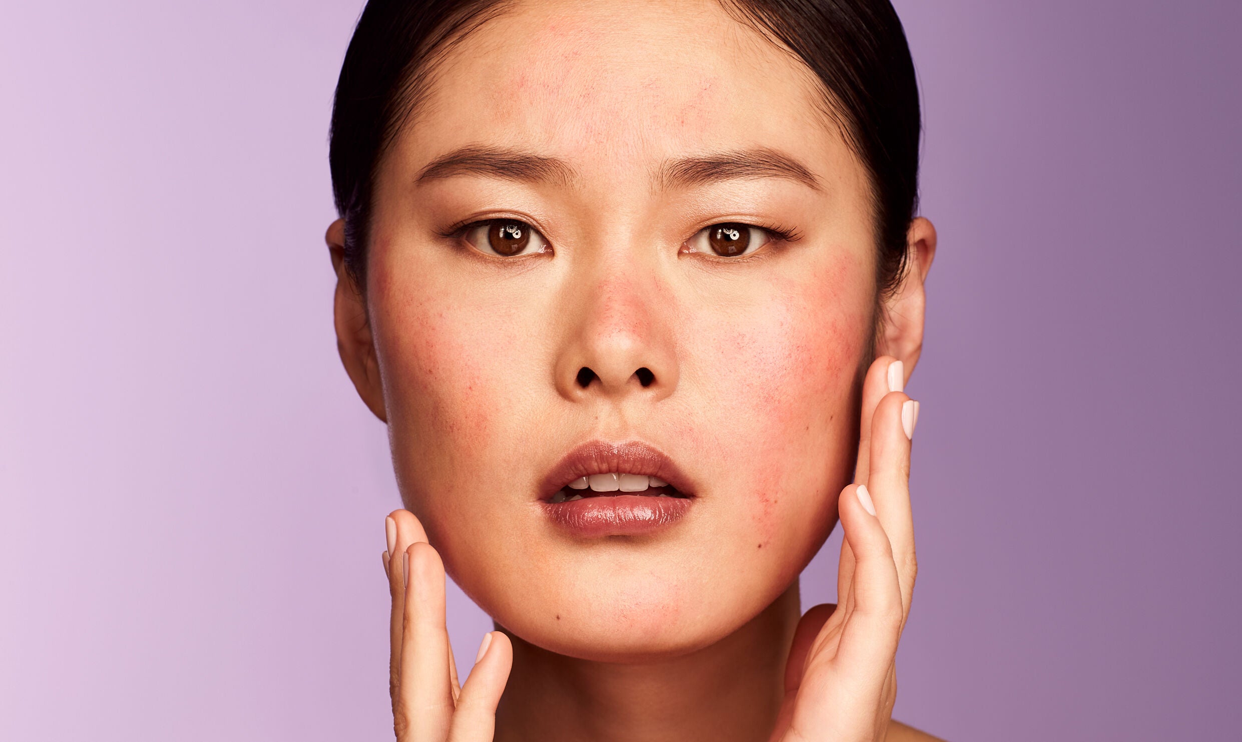 4 REMEDIES GOOD FOR HELPING SUNBURN – Kate Somerville US 4 REMEDIES GOOD FOR HELPING SUNBURN – Kate Somerville US