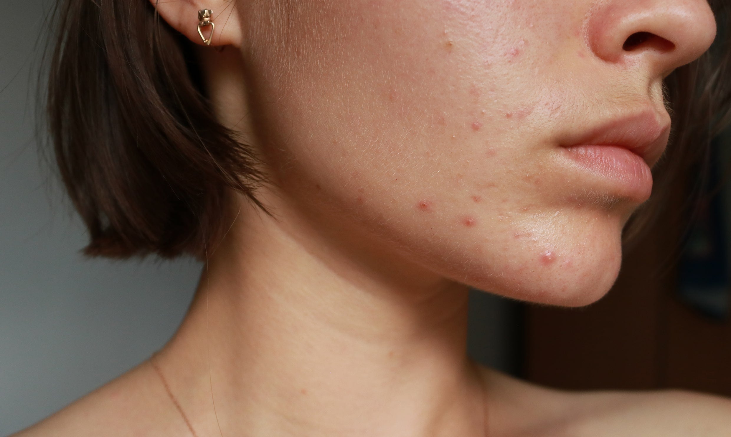 How Do I Know If My Acne Is Hormonal? How Do I Know If My Acne Is Hormonal?