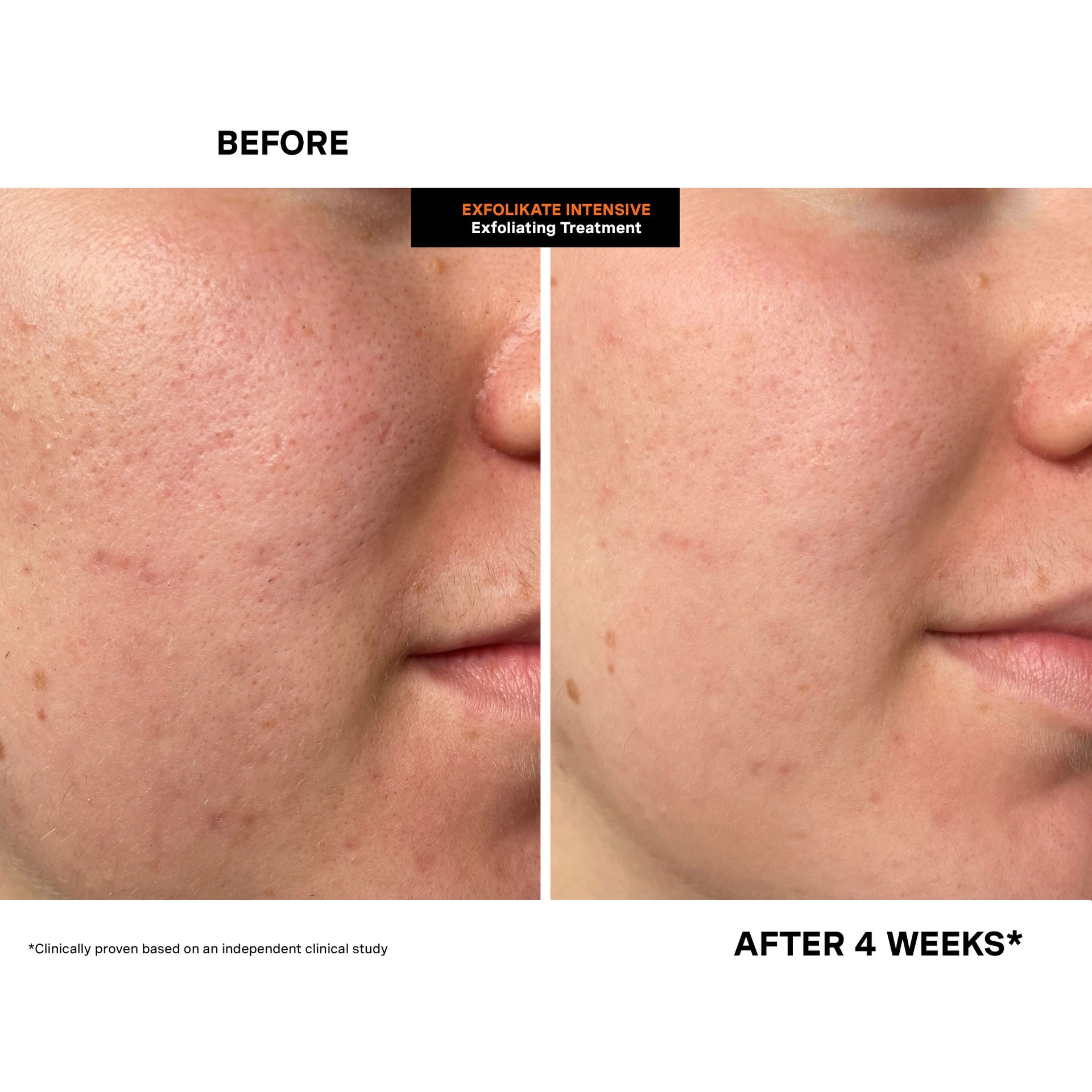 ExfoliKate® Intensive Exfoliating Treatment