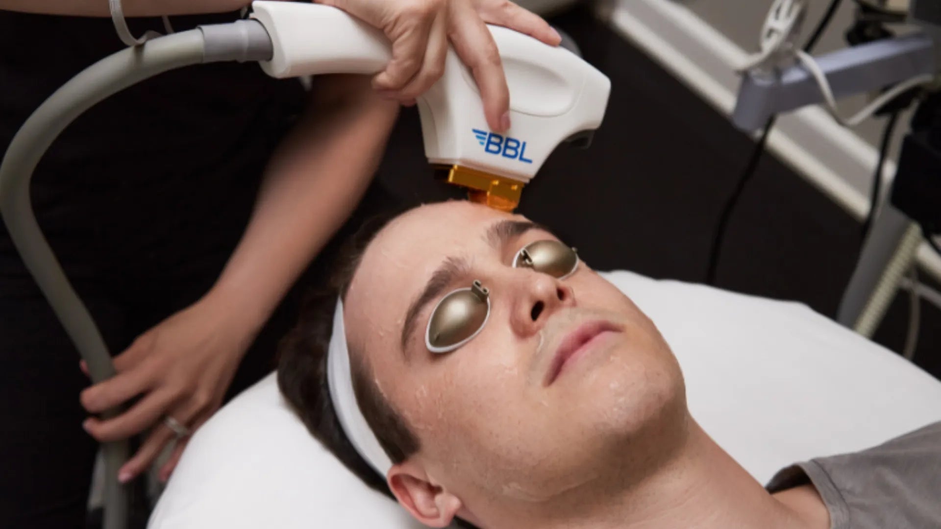How BBL Treatment Corrects Sun Damage and Rosacea