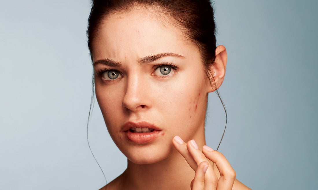 WHAT CAUSES ACNE IN ADULTS?