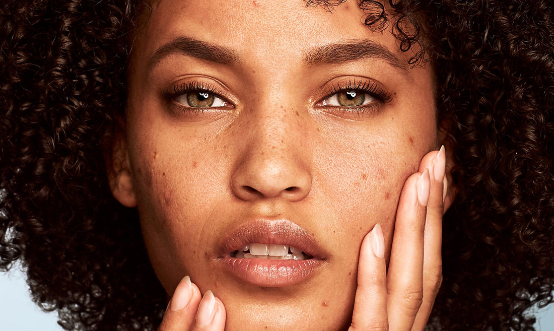 DOES VITAMIN E HELP WITH ACNE?