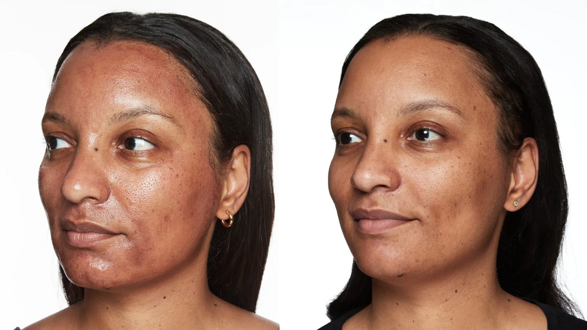 Collagen Induction Therapy: The Secret to Firmer, Younger-Looking Skin