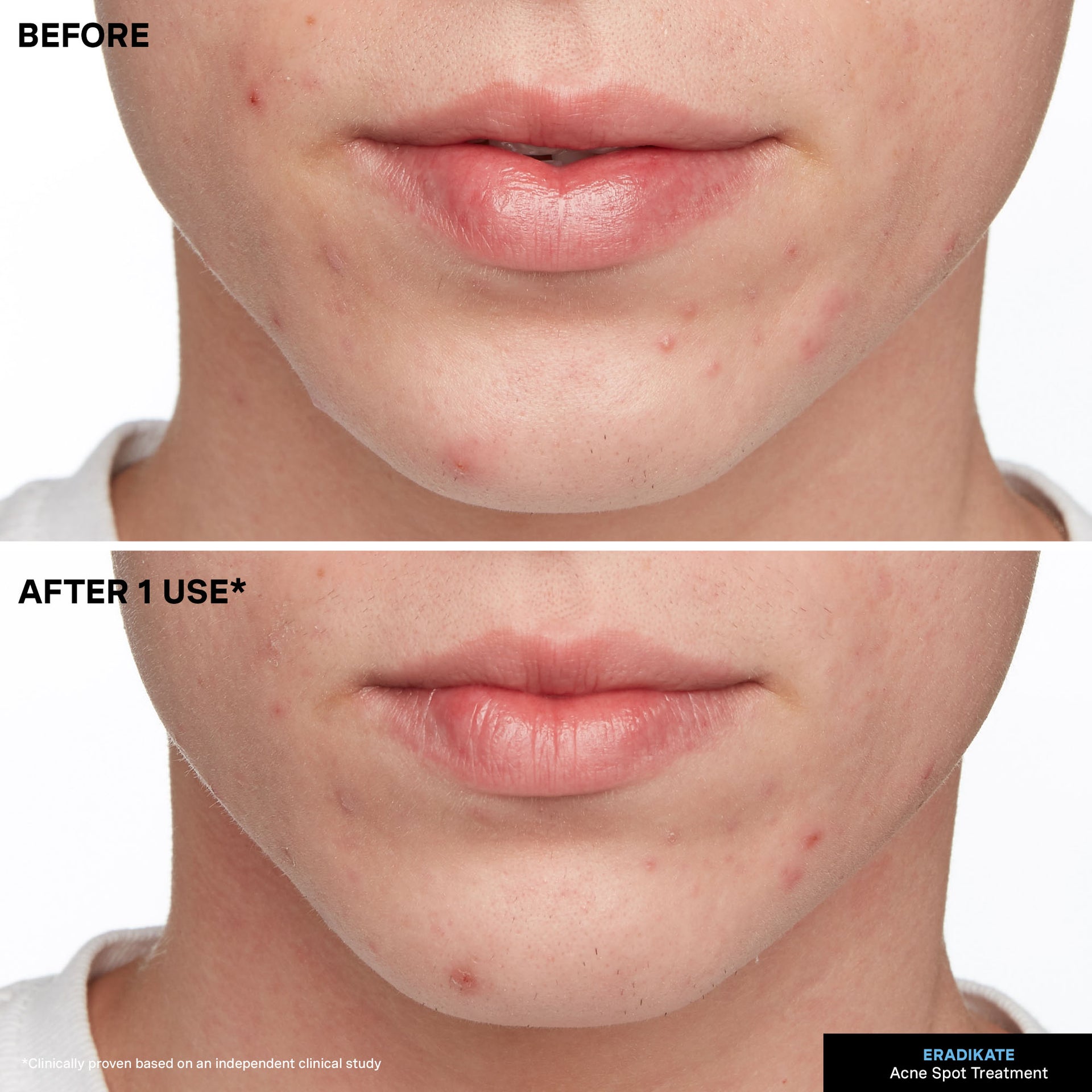 EradiKate® 10% Sulfur Acne Treatment