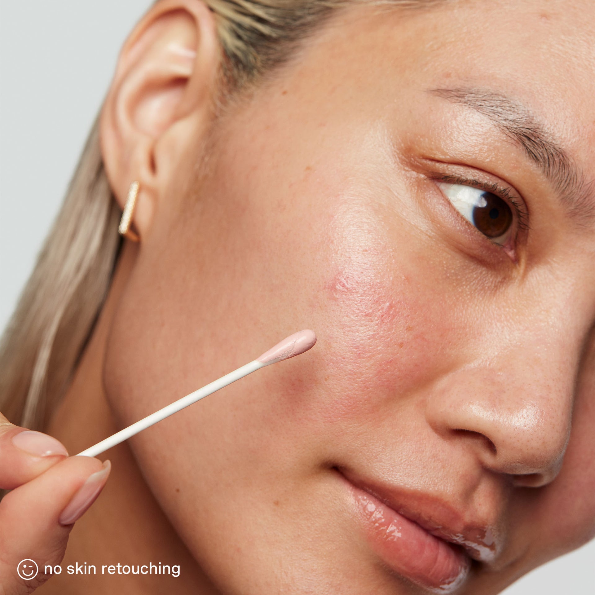 EradiKate® 10% Sulfur Acne Treatment