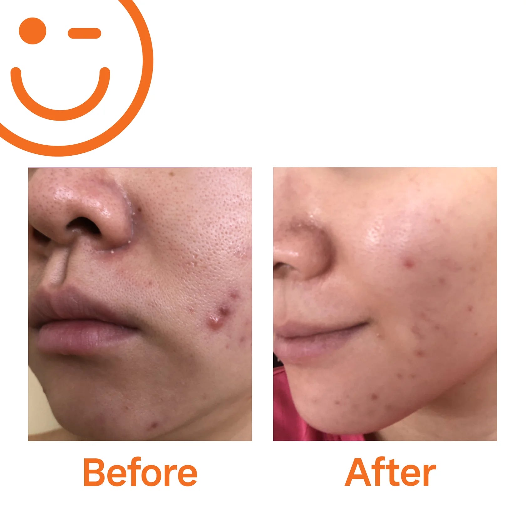 EradiKate™ 3% Sulfur Daily Foaming Cleanser Duo