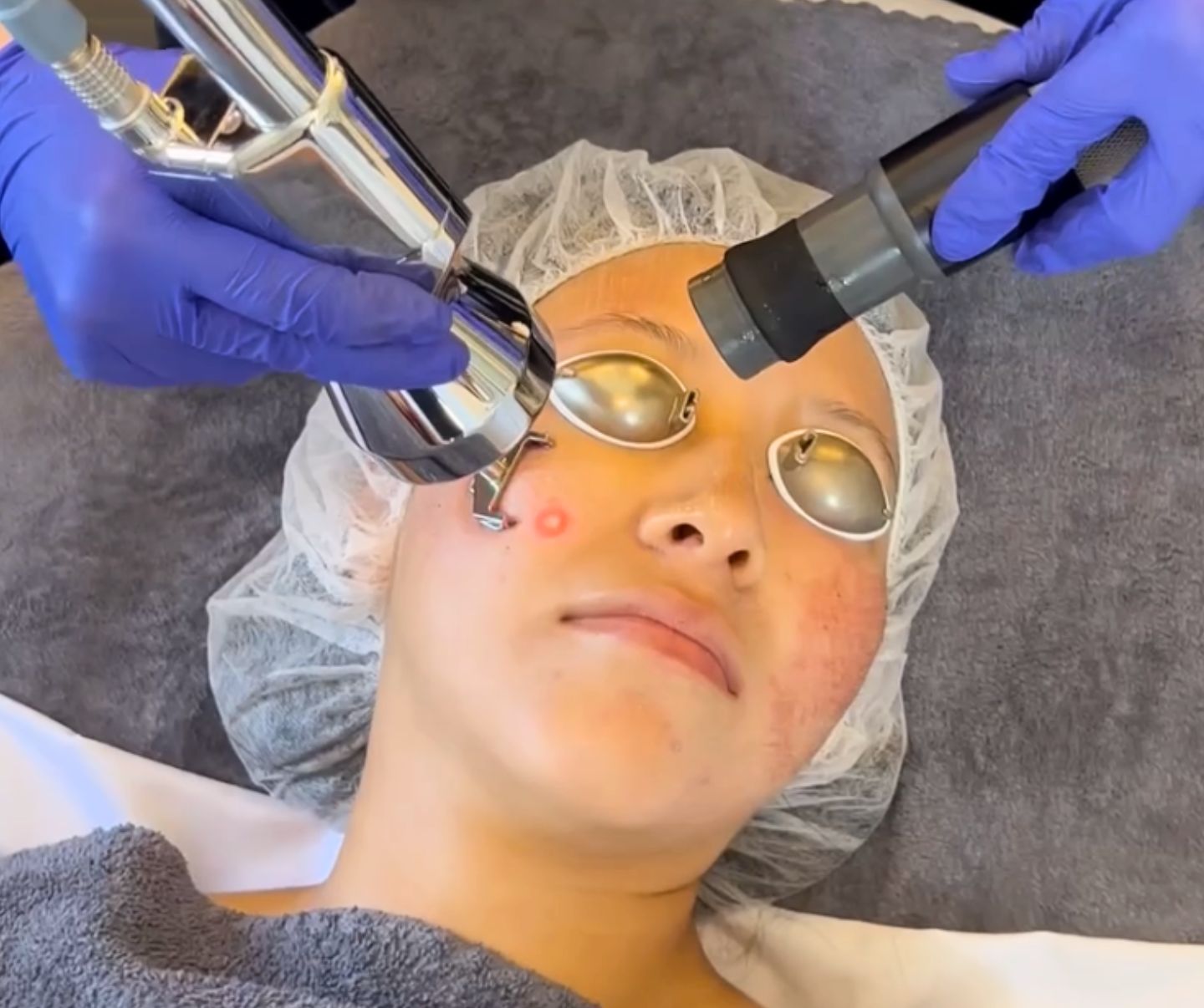 Profractional + Micro Laser Peel – Kate Somerville US