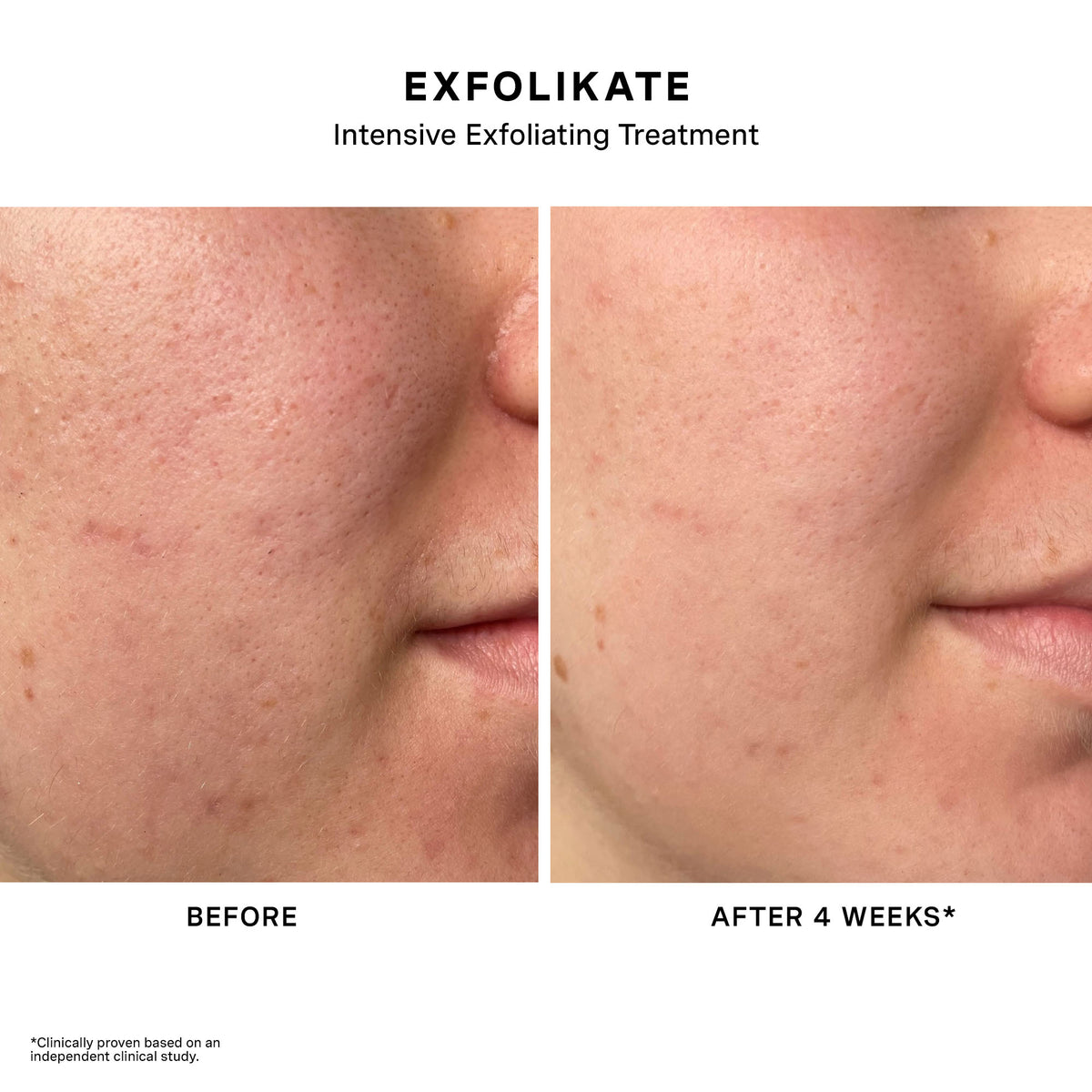 Before and after 4 weeks of ExfoliKate Intensive Exfoliating Treatment, close-up of cheek texture and pores